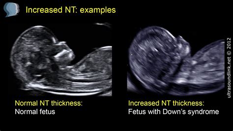 ultrasound fetal nuchal thickness measurement|nuchal translucent thickness chart.